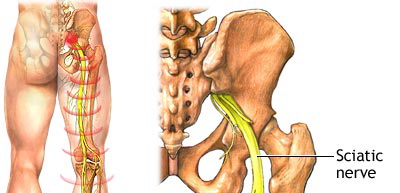 Sciatica can be treated effectively at The House Clinics, Bristol