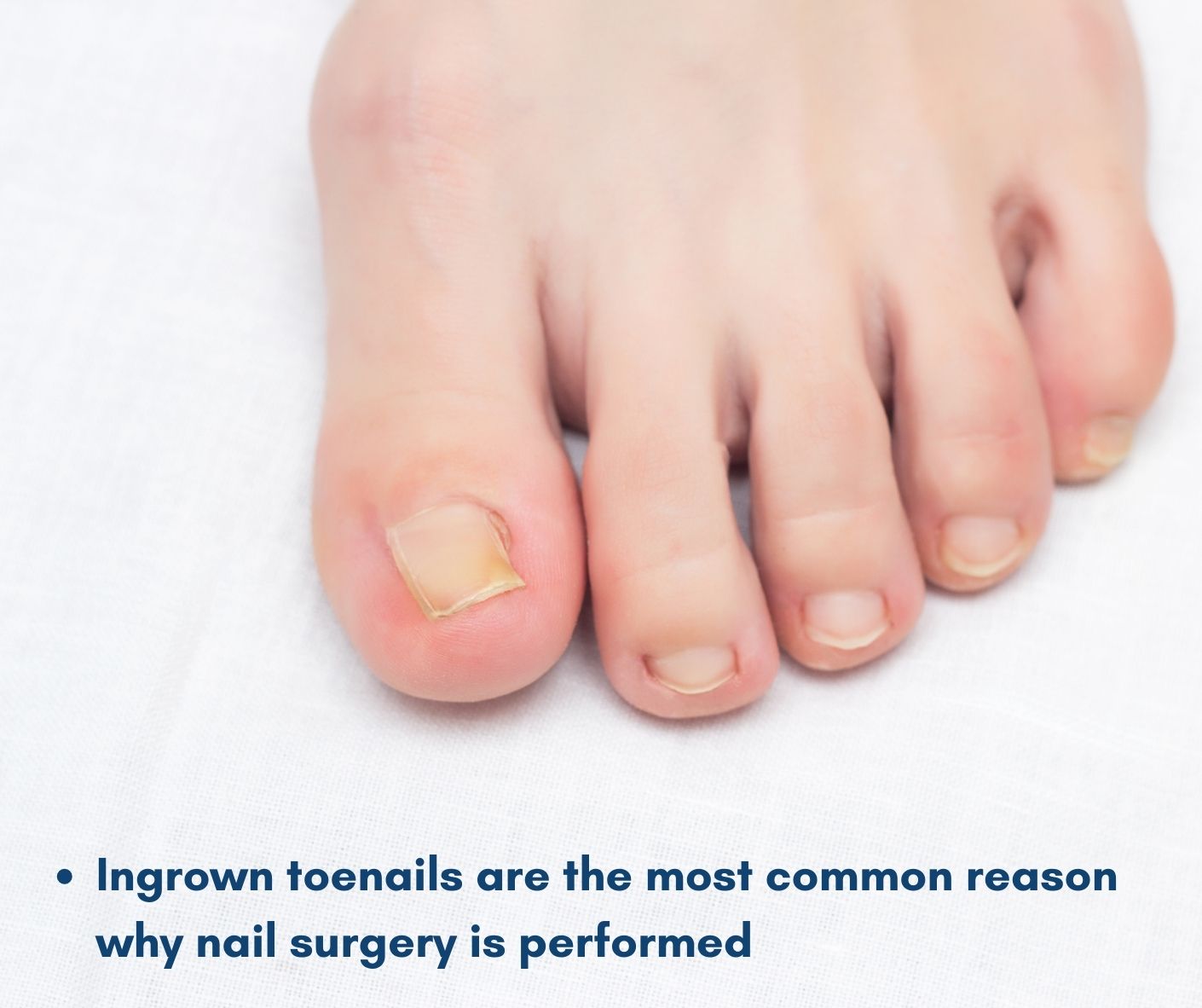 Ingorwn toenails are the most common reason why nail surgery is performed, The House Clinics Podiatry, Bristol