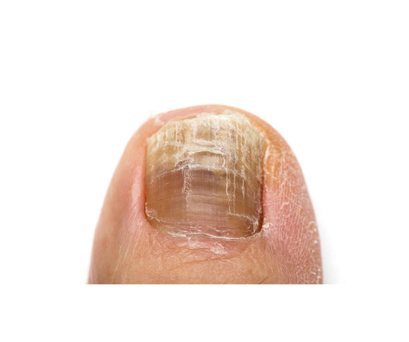 Thickened toenails can be treated by a podiatrist at The House Clinics, Bristol